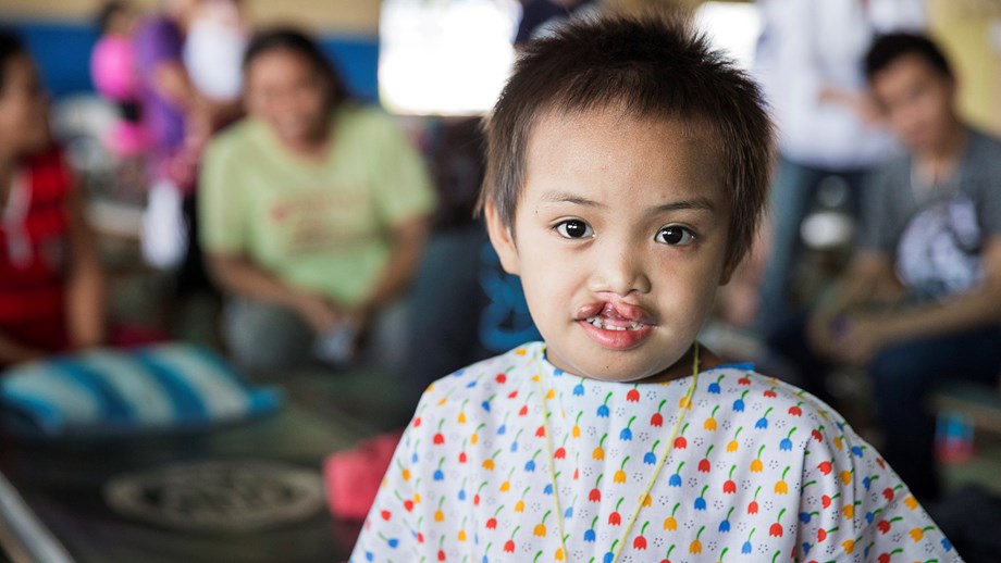 Filippiiniläistyttö ennen huulihalkioleikkausta